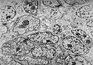 M,55y. | small cell carcinoma - lung